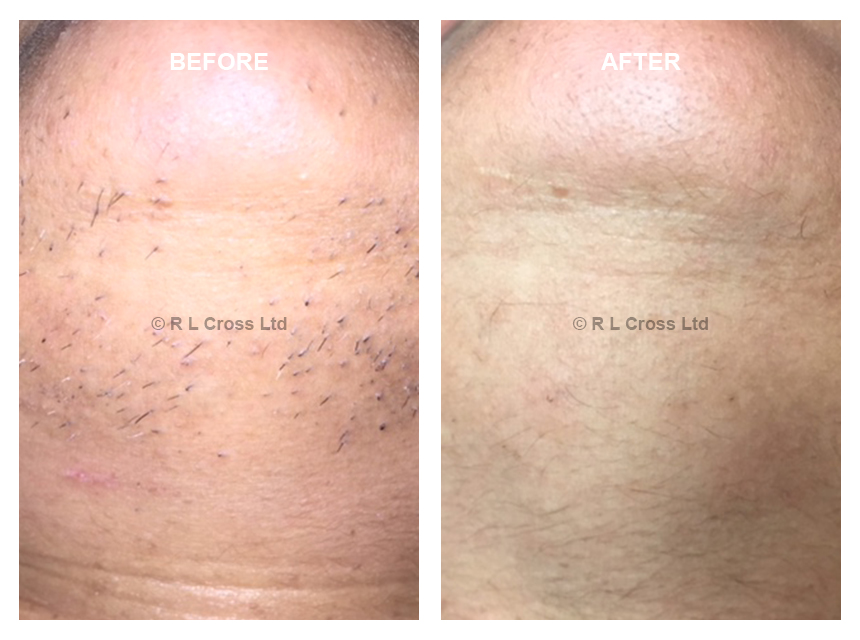 Before & After Electrolysis Treatment | RACHEL LOUISE CROSS
