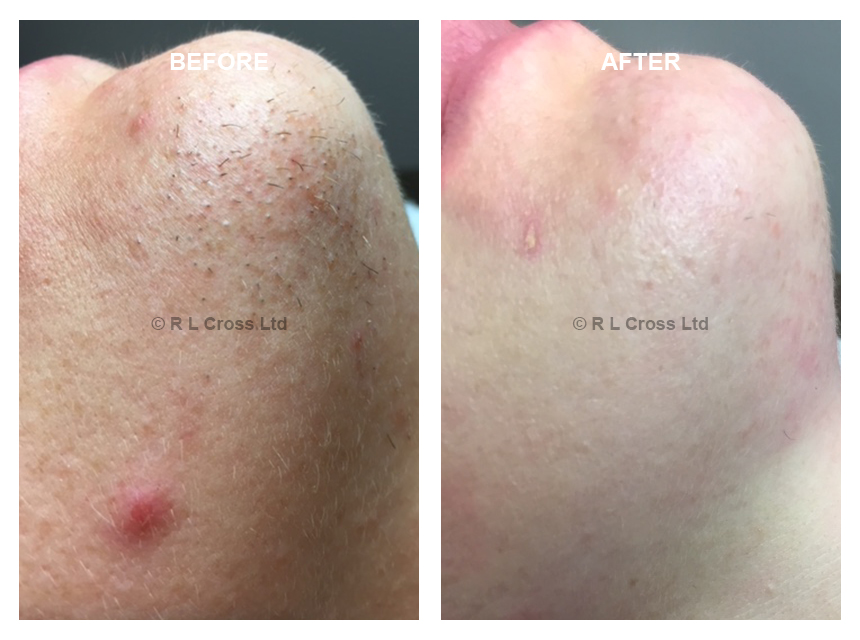 Before & After Electrolysis Treatment RACHEL LOUISE CROSS