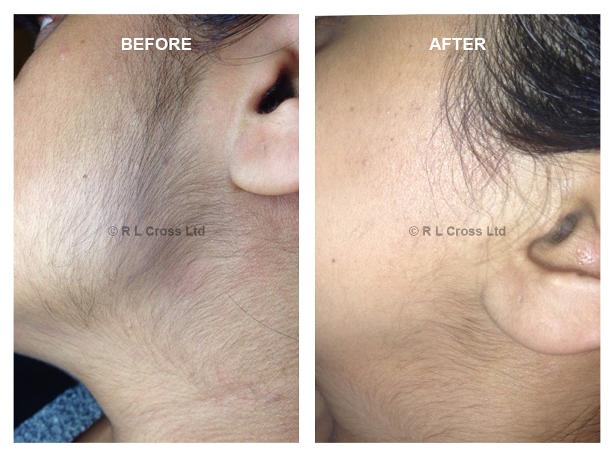 Laser Hair Removal vs. Electrolysis - Which Procedure is Best and Why